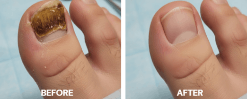 Mycotraxin Customer Reviews